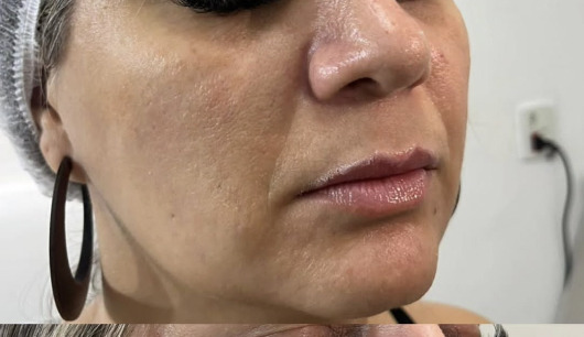 Rosto antes da harmonização facial