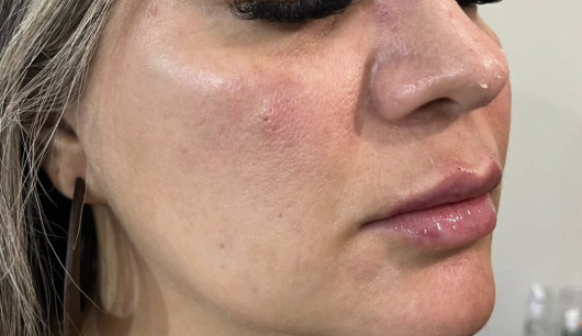 Rosto depois da harmonização facial