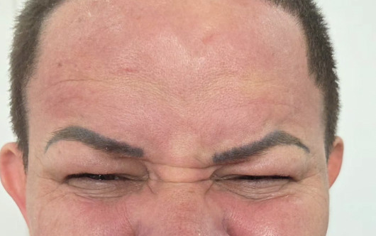 Testa antes da toxina botulínica